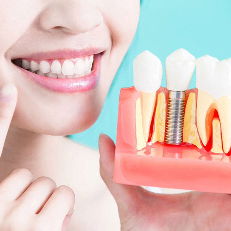 Dental Implants is a good option