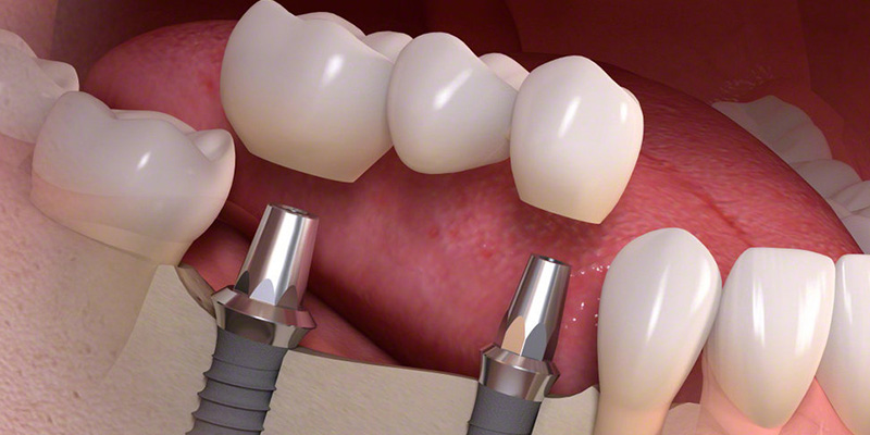 Multiple Teeth Implants