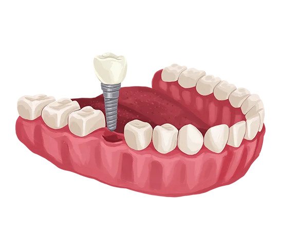 Single Tooth Implant