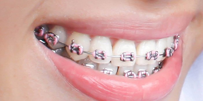 Dental Braces (Orthodontics)