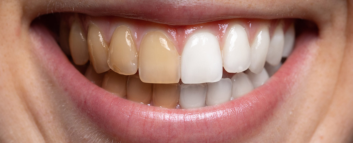 Teeth Whitening in Mumbai, The Definitive Guide