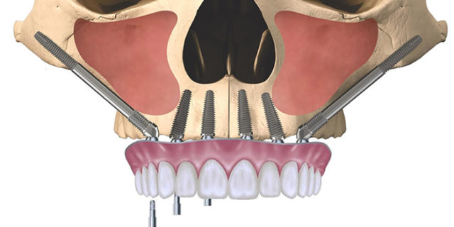 Dental Implants Cost India Australia | Implants Clinic India & Australia