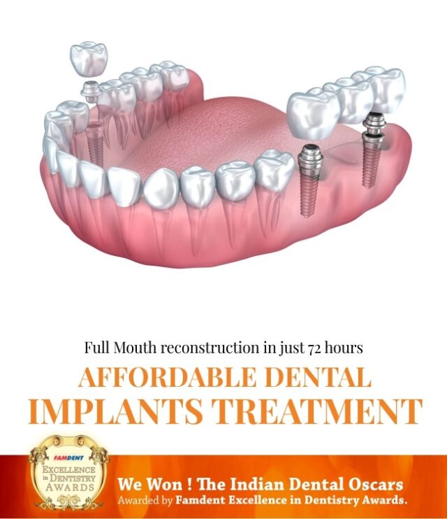 Full Mouth Dental Implants Cost in Mumbai, India