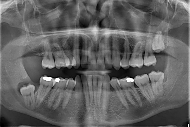 teeth x-rays in mumbai