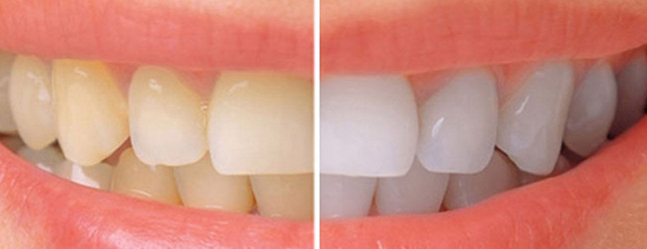cost of teeth whitening in mumbai-big