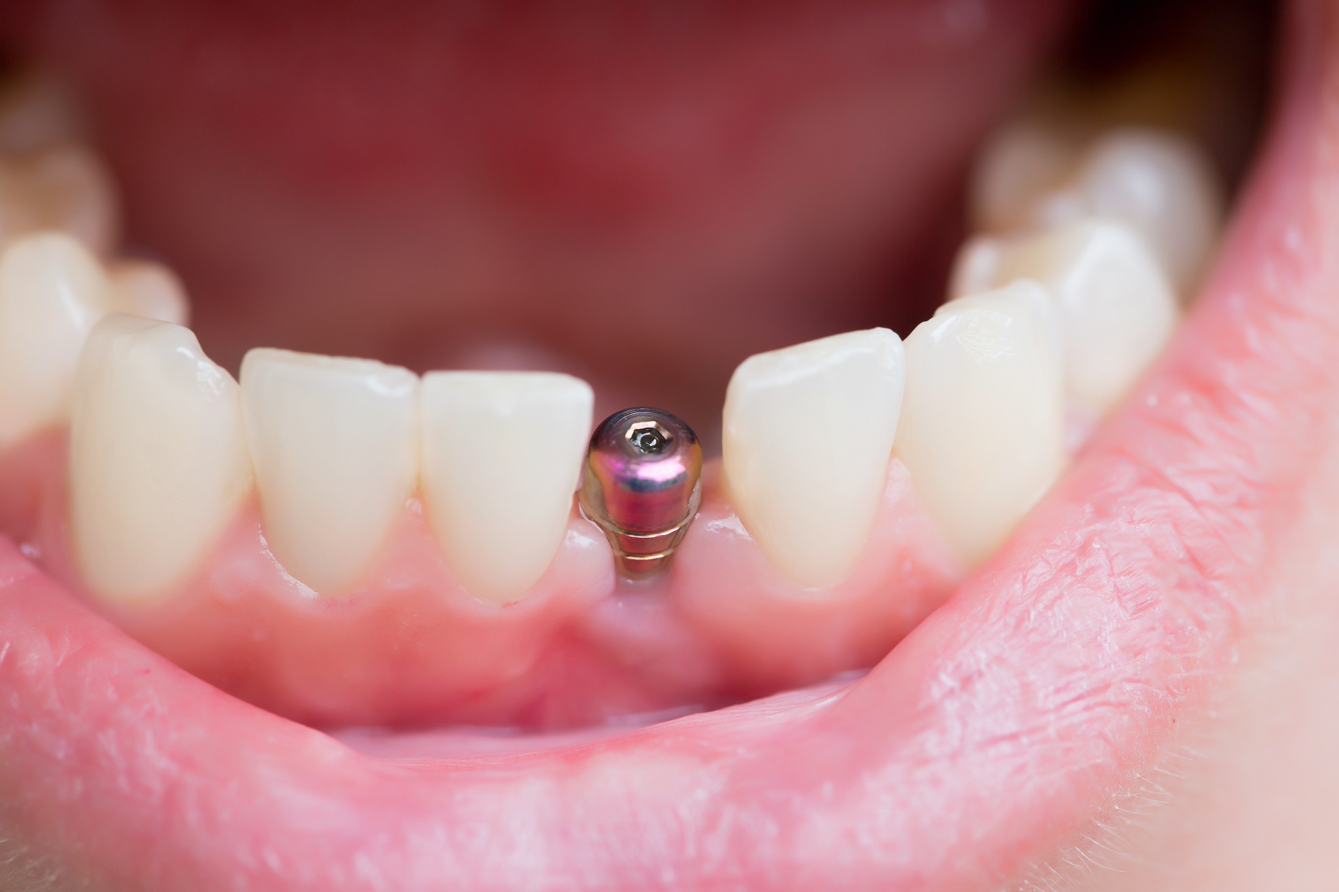 single tooth implants in india