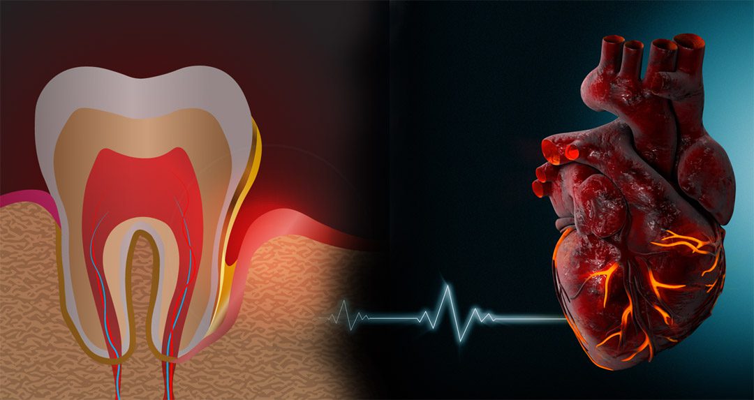 Why Taking Care of Your Teeth May Help Prevent Heart Disease