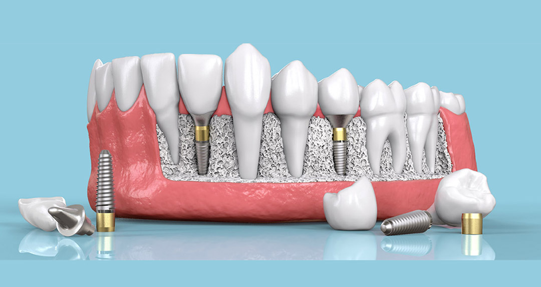 How Dental Implants Improve Overall Health Beyond Your Smile